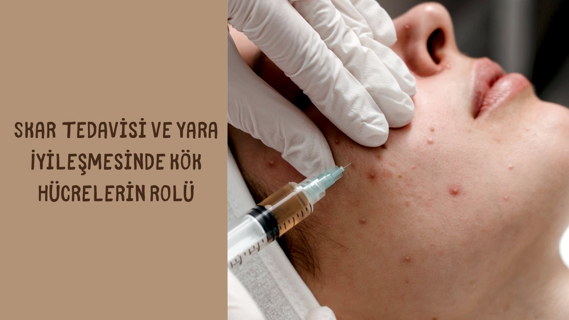Skar Tedavisi ve Yara İyileşmesinde Kök Hücrelerin Rolü