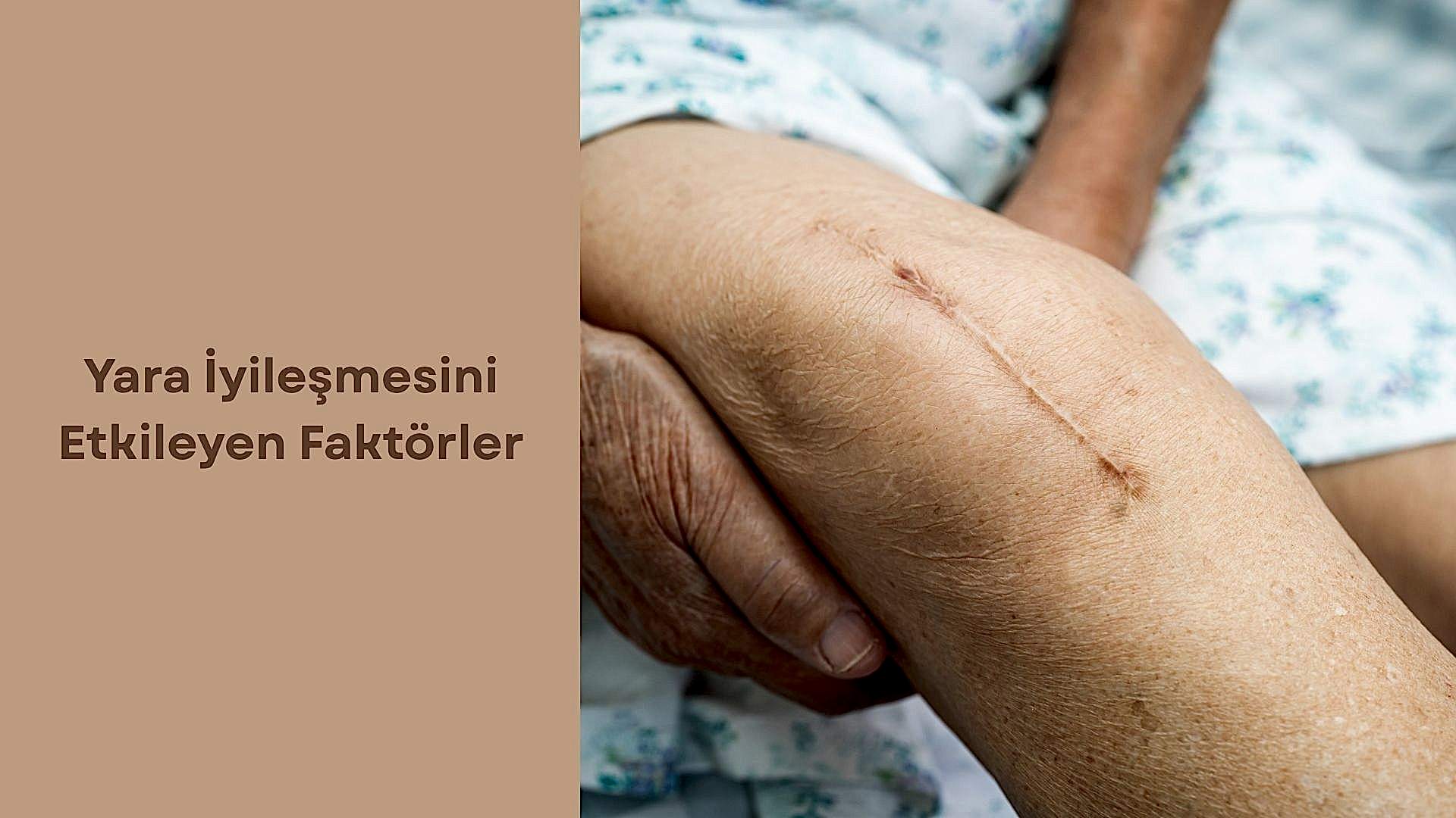 Yara İyileşmesini Etkileyen Faktörler
