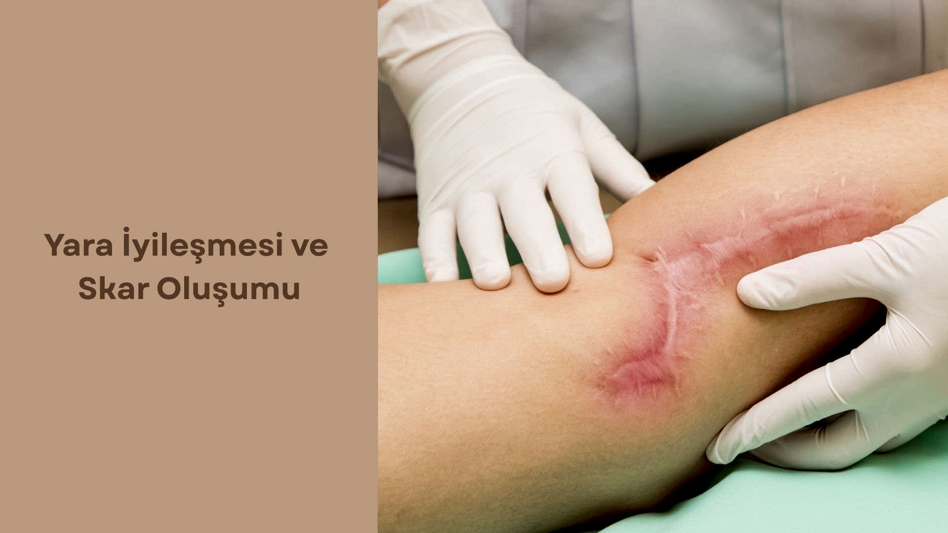 Yara İyileşmesi ve Skar Oluşumu