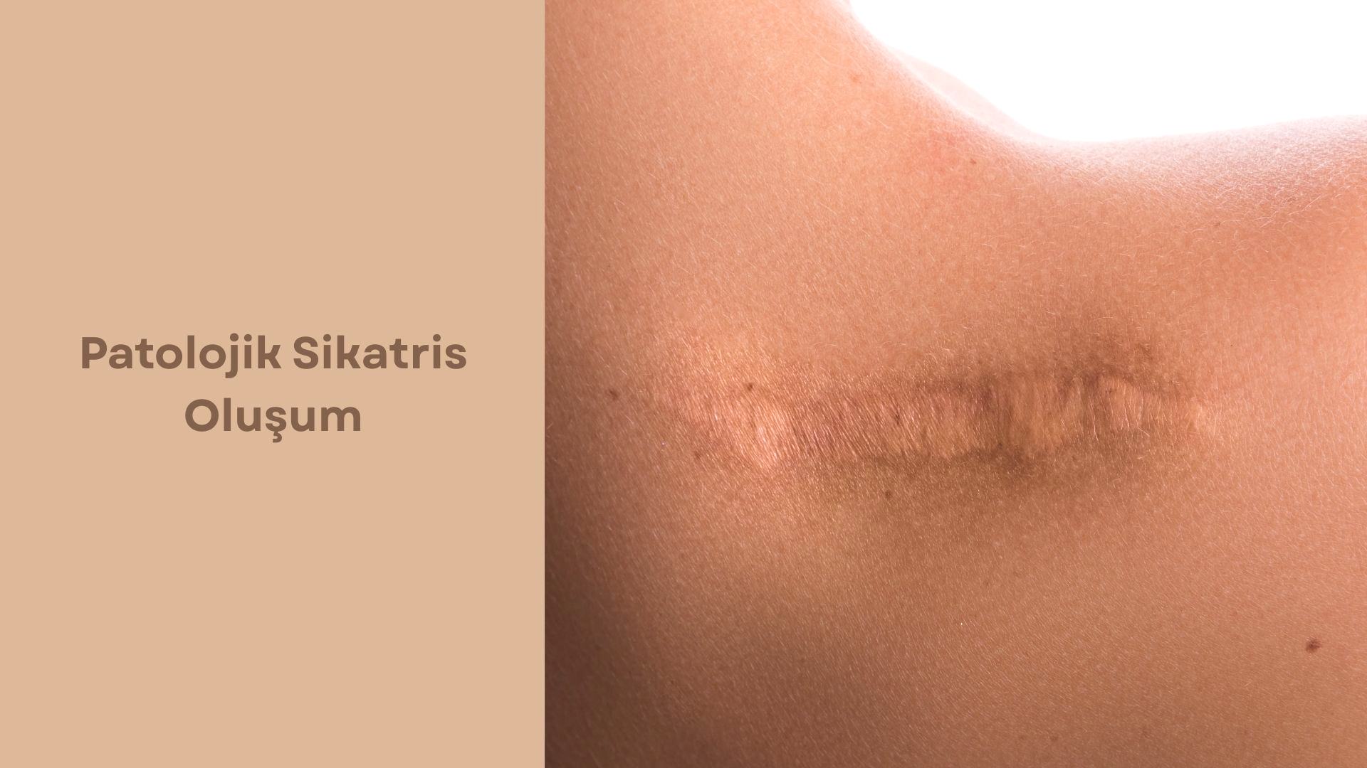 Patolojik Sikatris Oluşum