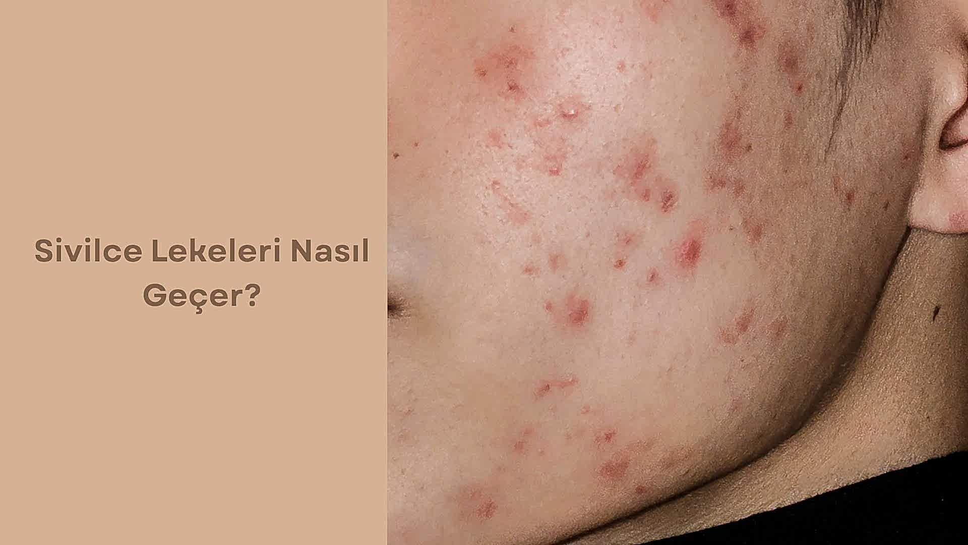 Akne Lekeleri Nasıl Geçer?