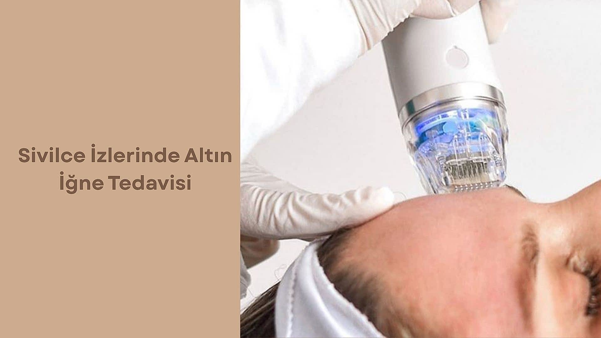 Sivilce İzlerinde Altın İğne Tedavisi