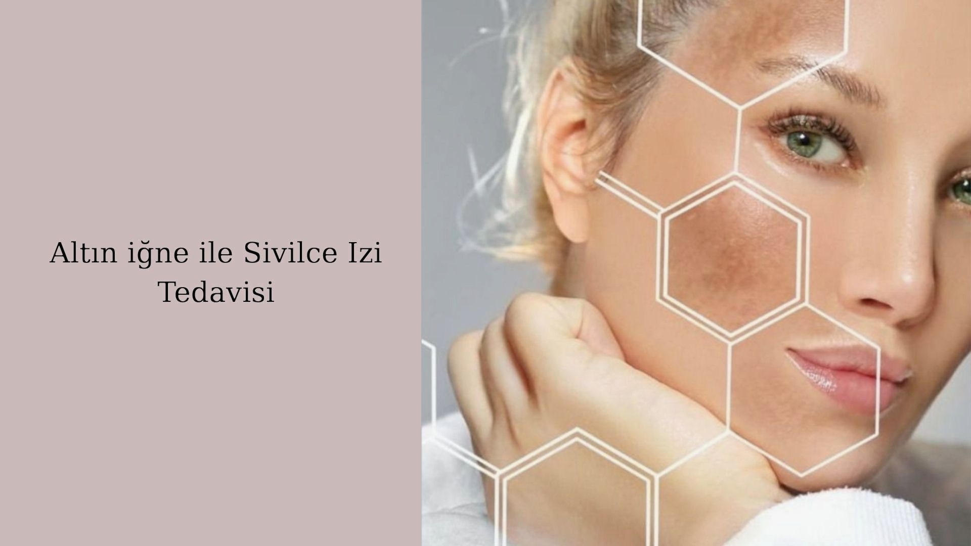 sivilce