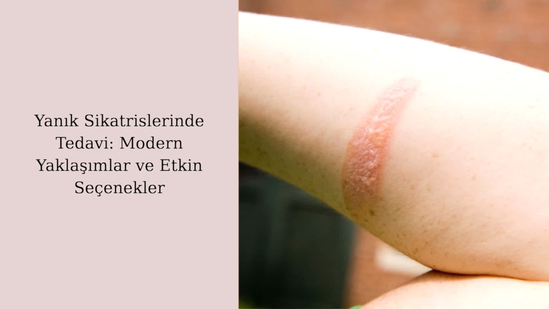 Yanık Sikatrislerinde Tedavi: Modern Yaklaşımlar ve Etkin Seçenekler