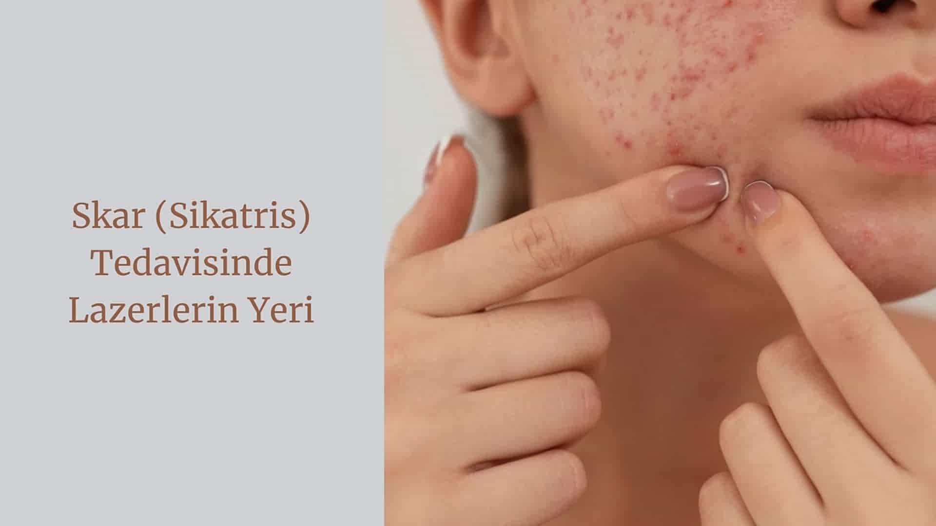 Skar (Sikatris) Tedavisinde Lazerlerin Yeri