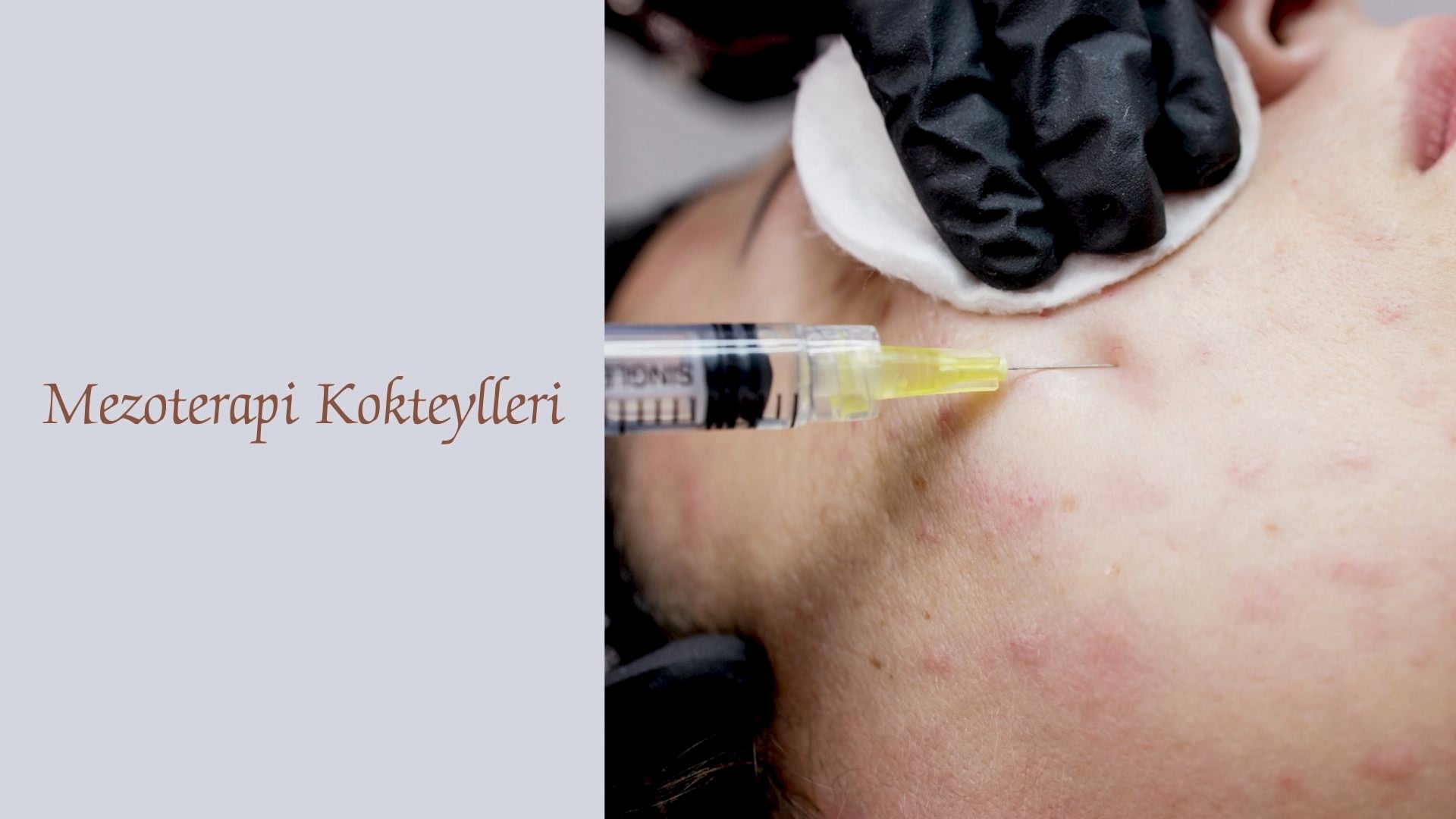 Biyorevitalizasyon ve Biyolifting Amaçlı Mezoterapi Kokteylleri