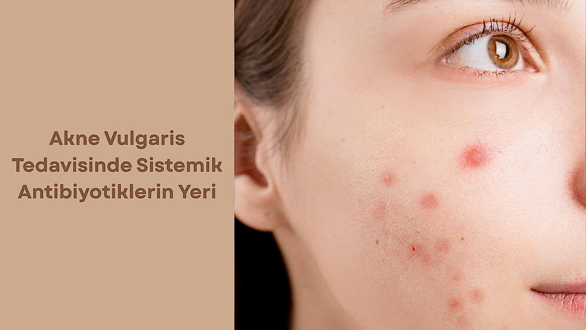 Akne Vulgaris Tedavisinde Sistemik Antibiyotiklerin Yeri