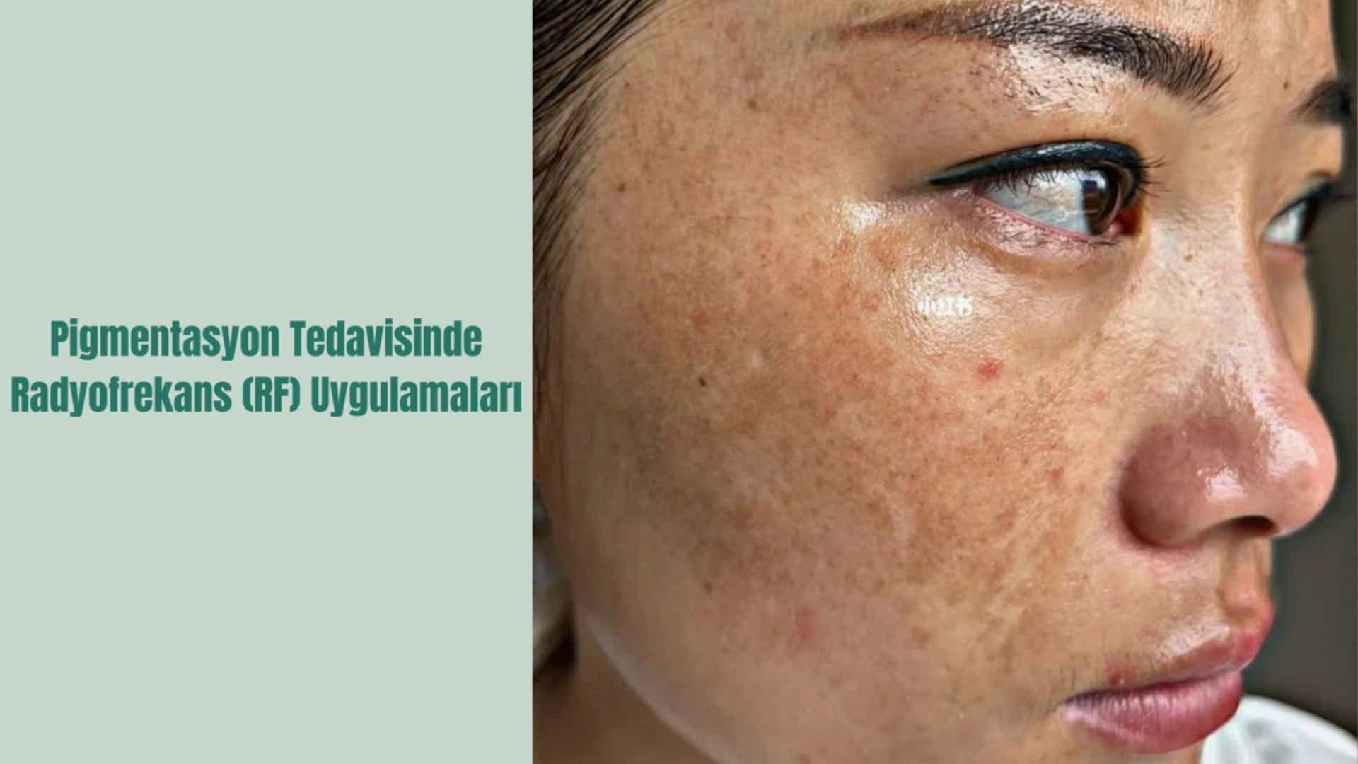 Pigmentasyon Tedavisinde Radyofrekans (RF) Uygulamaları