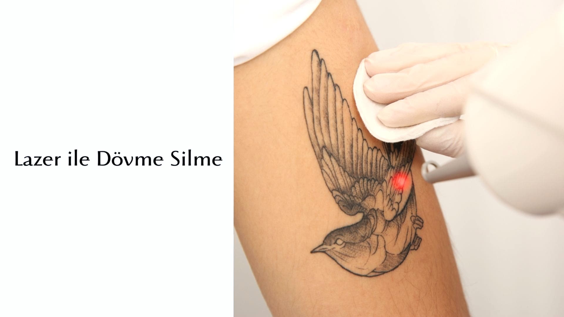 Lazer İle Dövme Silme 