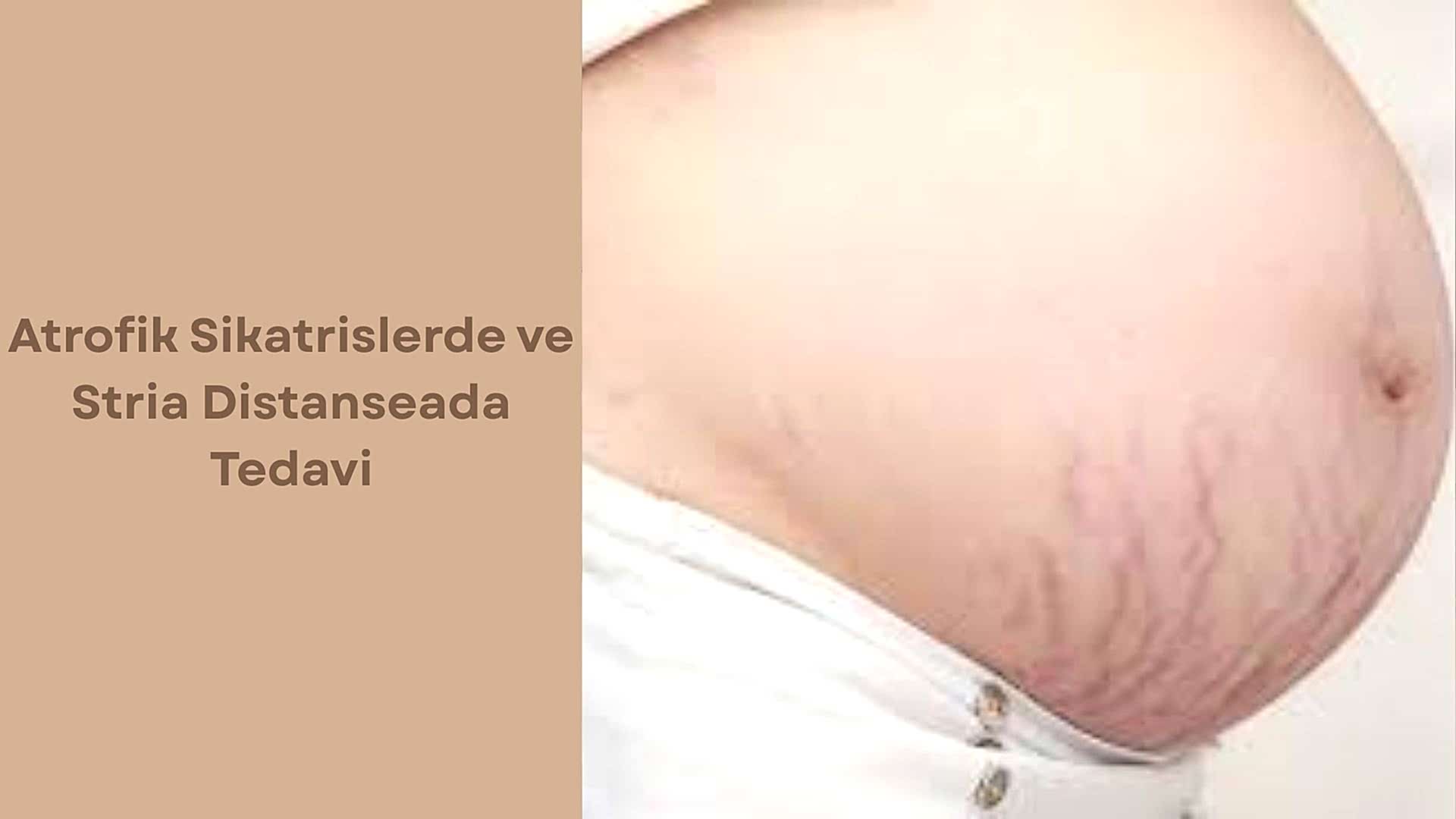Atrofik Sikatrislerde ve Stria Distanseada Tedavi