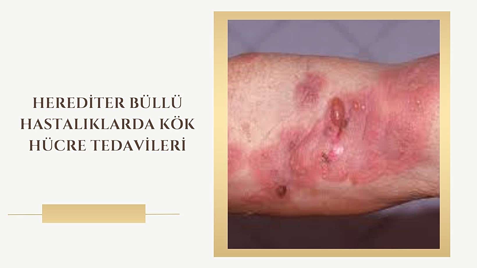 Herediter Büllü Hastalıklarda Kök Hücre Tedavileri