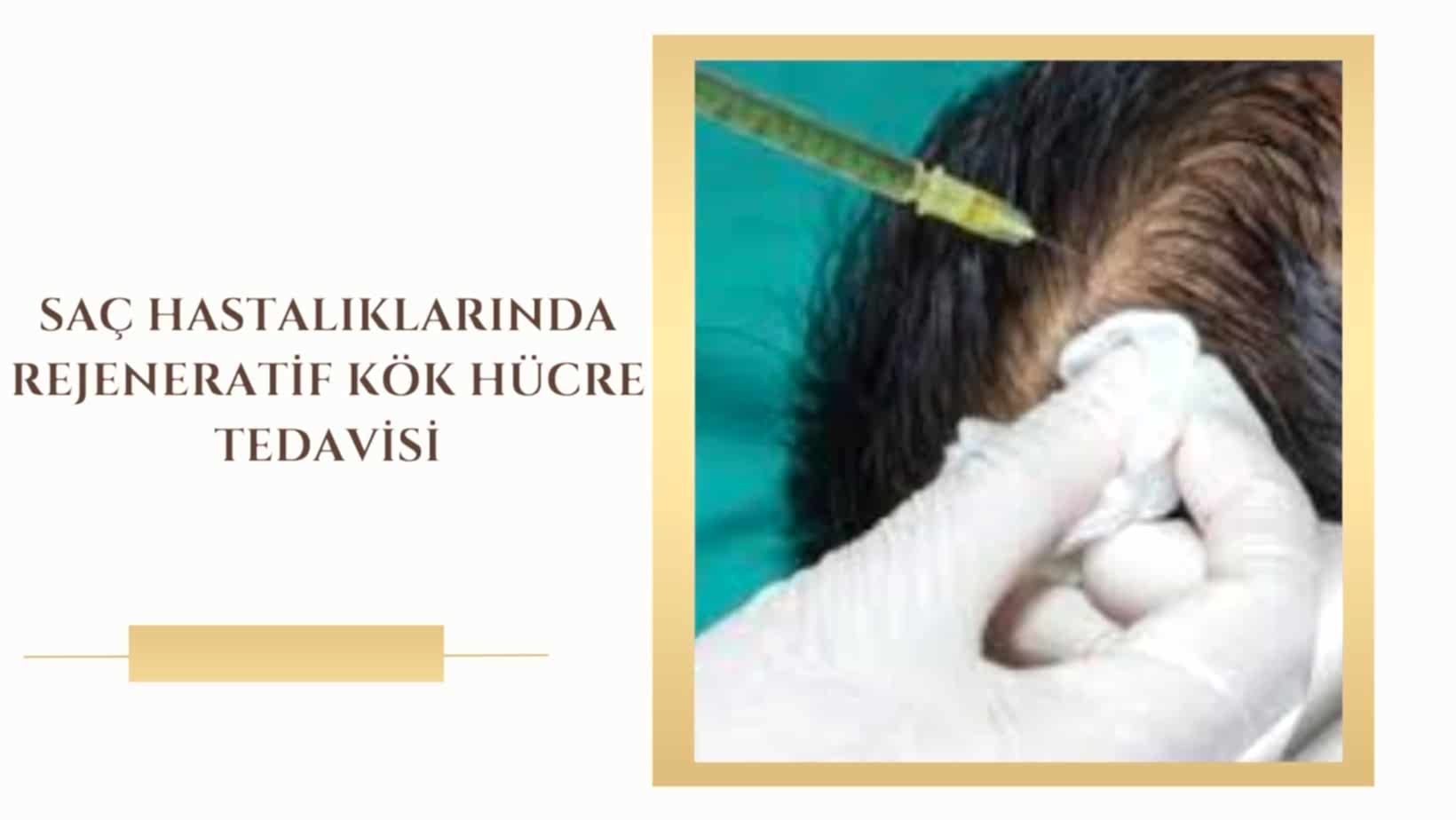 Saç Hastalıklarında Rejeneratif Kök Hücre Tedavisi