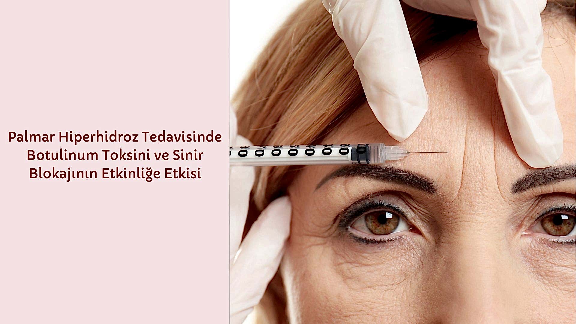 Palmar Hiperhidroz Tedavisinde Botulinum Toksini ve Sinir Blokajının Etkinliğe Etkisi