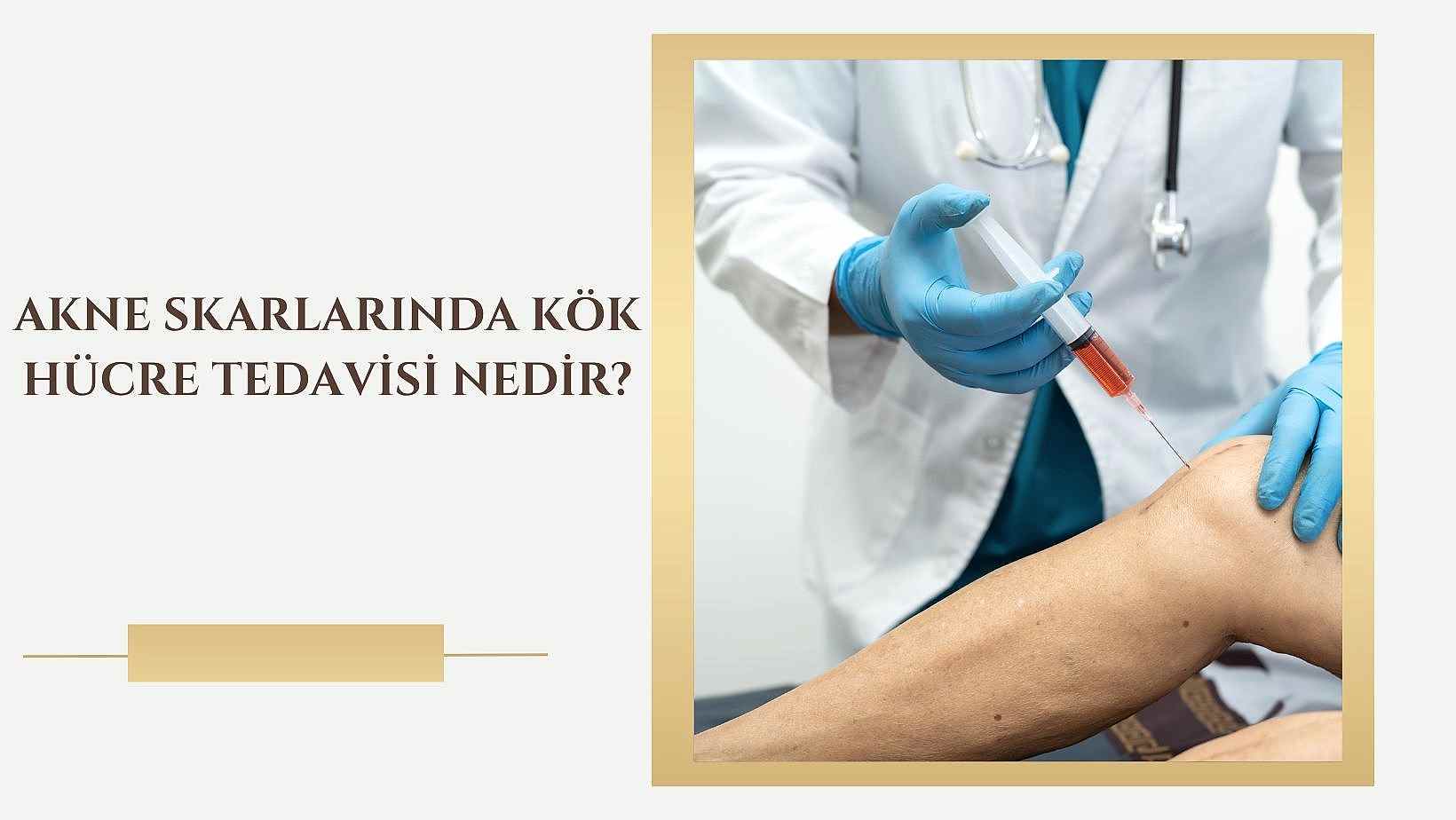 Akne Skarlarında Kök Hücre Tedavisi Nedir?