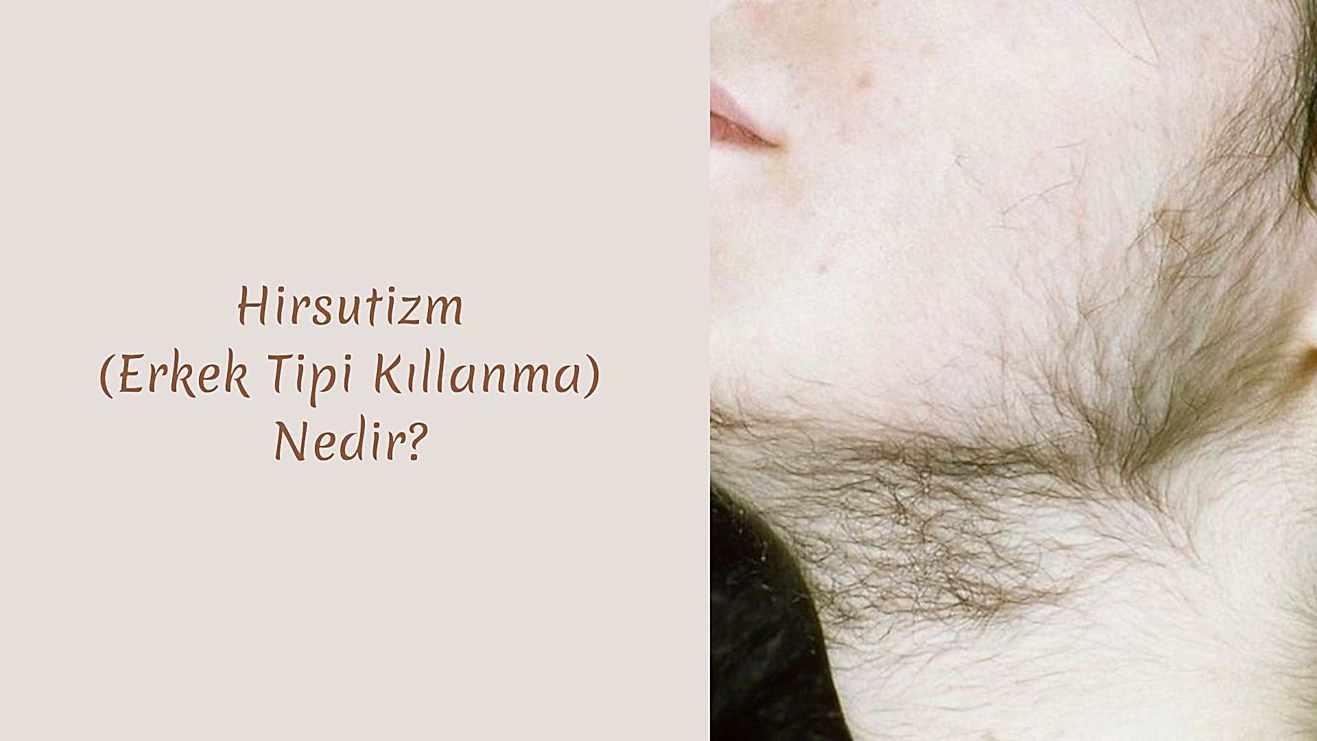 Hirsutizm (Erkek Tipi Kıllanma) Nedir?