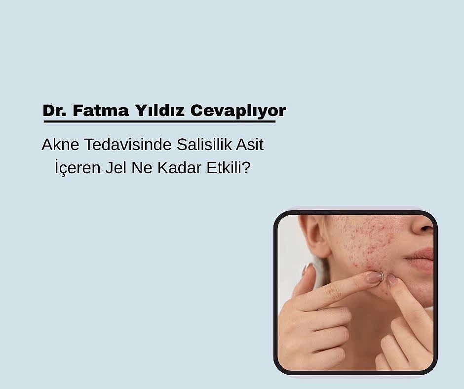 Akne Tedavisinde Salisilik Asit İçeren Jel Ne Kadar Etkili?