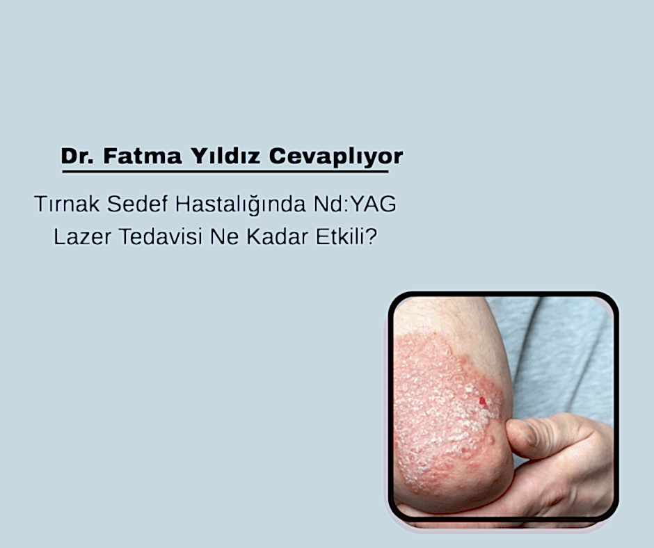 Tırnak Sedef Hastalığında Nd:YAG Lazer Tedavisi Ne Kadar Etkili?